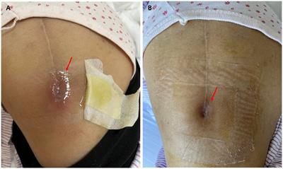 Case report: Occult Listeria monocytogenes invasion leading to prosthetic hip joint infection in a patient with rheumatoid arthritis taking tofacitinib